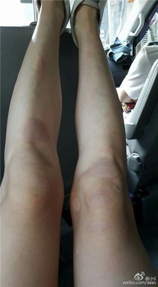小S美腿伤痕累累 自侃：只能靠脸了