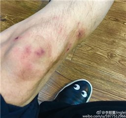 李靓蕾晒王力宏伤照 手腿伤横累累二嫂超心疼